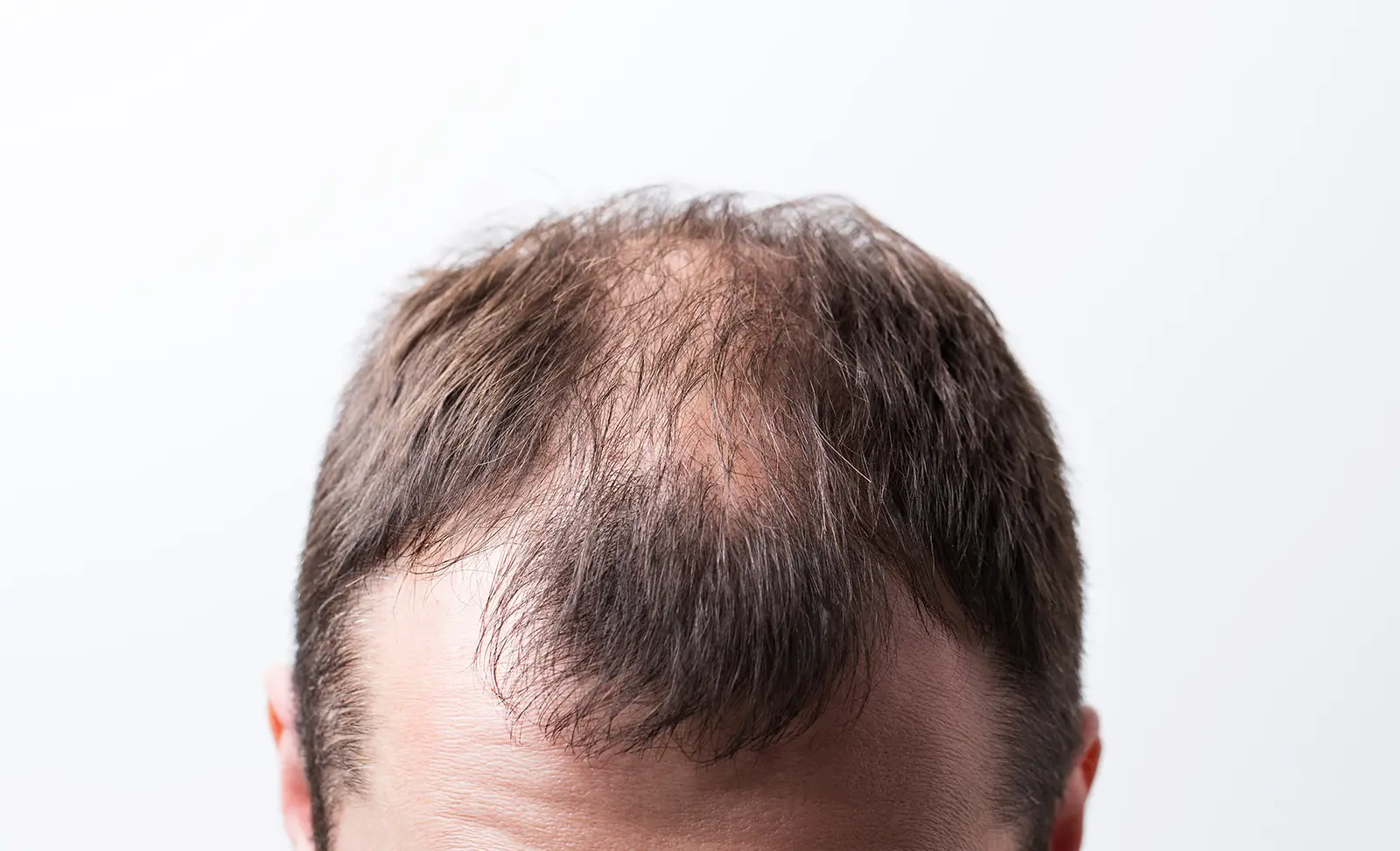 17645932791764593266377Close-up-balding-head-of-man-on-white-background.webp