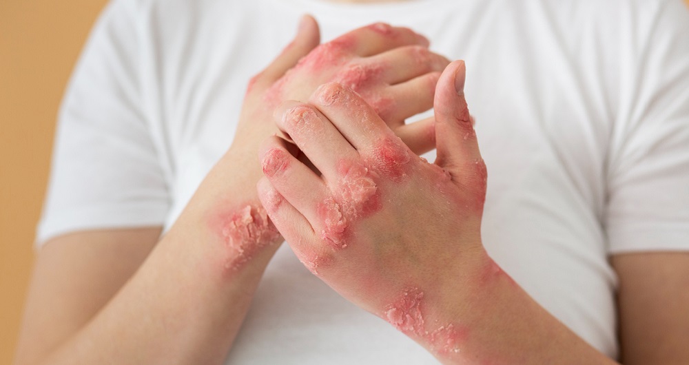 17645936201764593606970Treating-EczemaPsoriasis-with-kerala-Ayurvedic.jpg